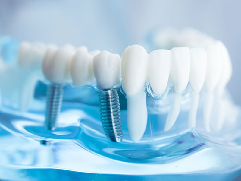 a piacenza e provincia lo studio bosi si occupa di implantologia dentale
