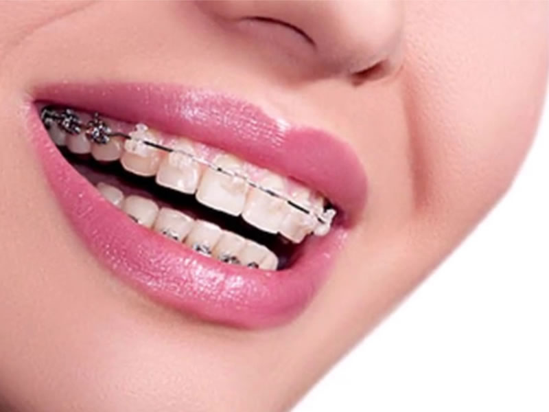 ortodonzia-piacenza-1 servizio di ortodonzia a piacenza